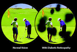 Diabetic Retinopathy Affects by Synergy Eye Care