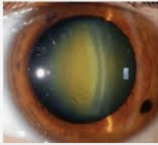 Cataract Treatment by Synergy Eye Care